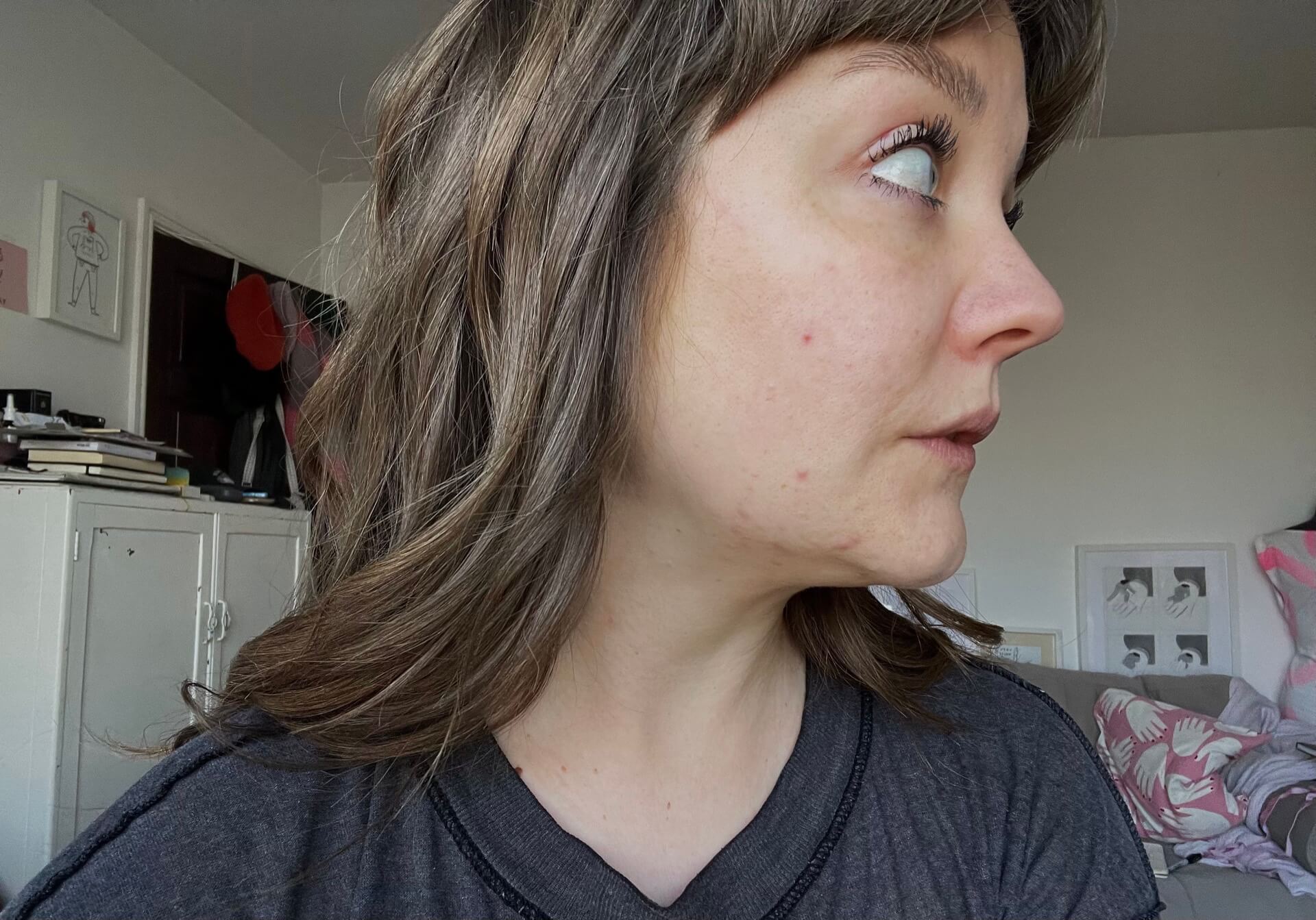 Right side view of Lyzi's face with hormonal acne