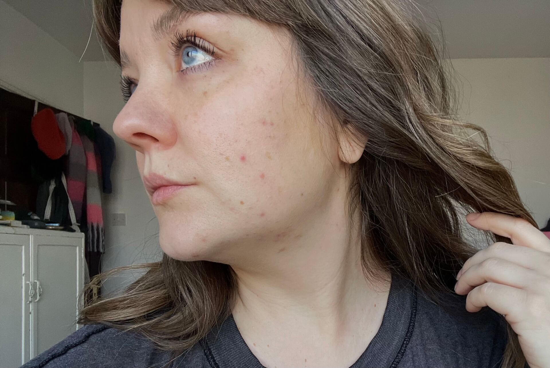 Left side view of Lyzi's face with hormonal acne