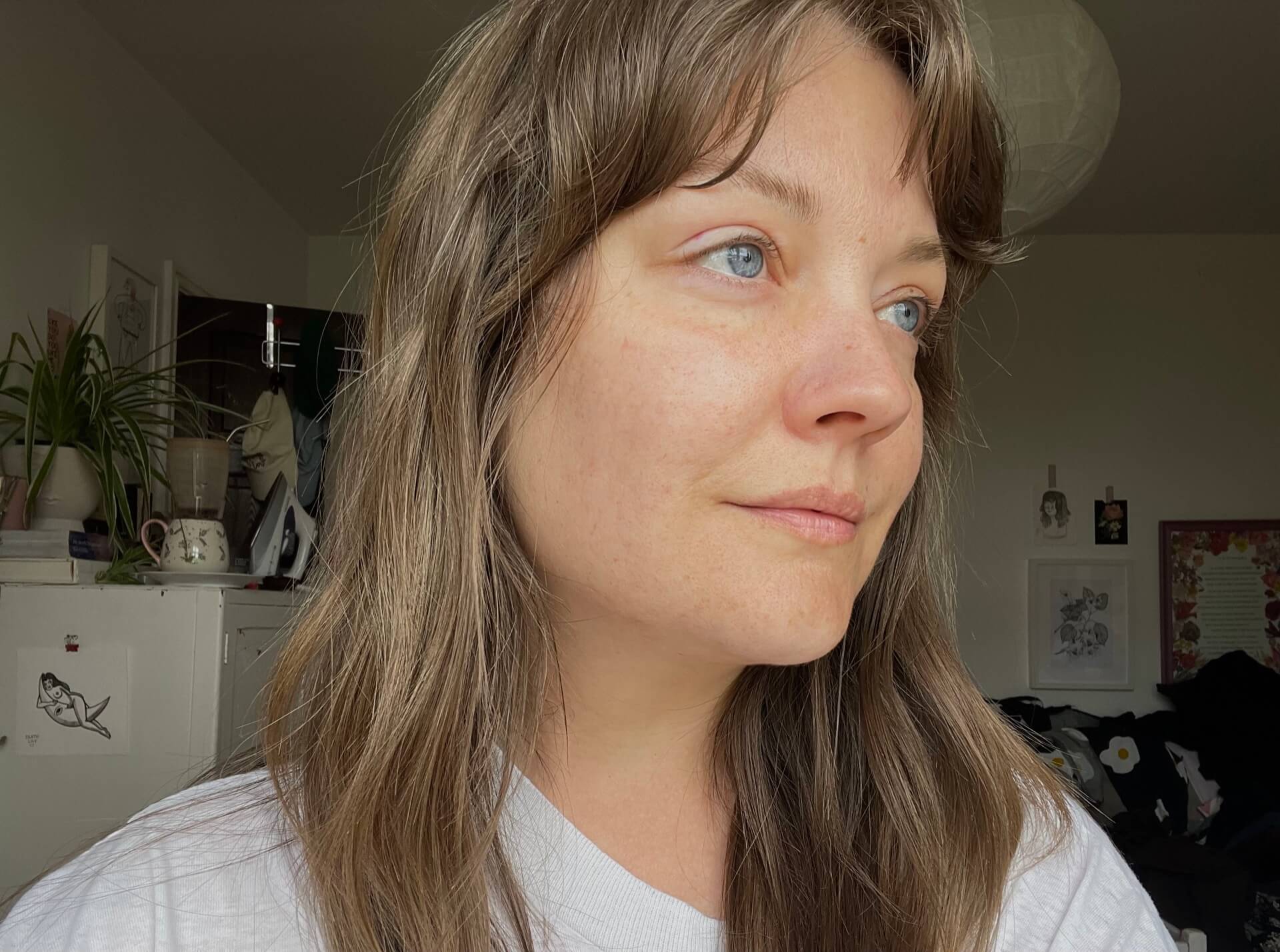 Right side of Lyzi's face after trying solutions for adult acne
